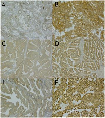 Redox-state-regulating enzymes have prognostic value in diabetic endometrial cancer patients: impact of statin use?